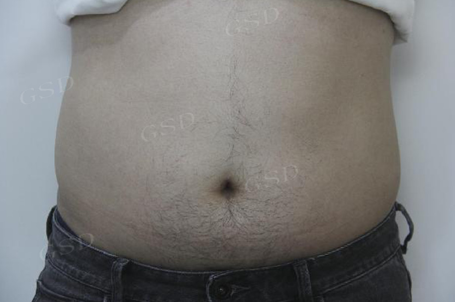 ThermaSculpt before1