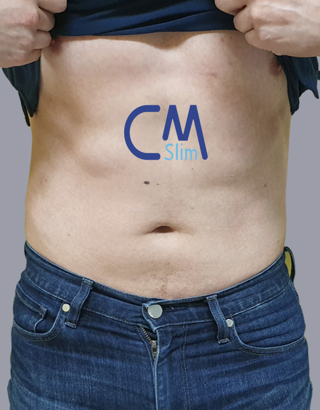 after-treatment