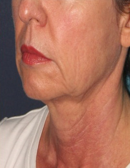 Chin and Neck HIFU After