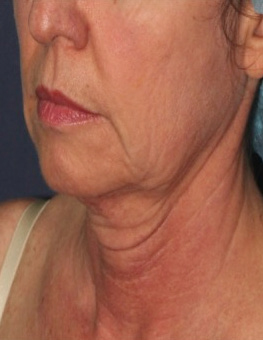 Chin and Neck Hifu Before
