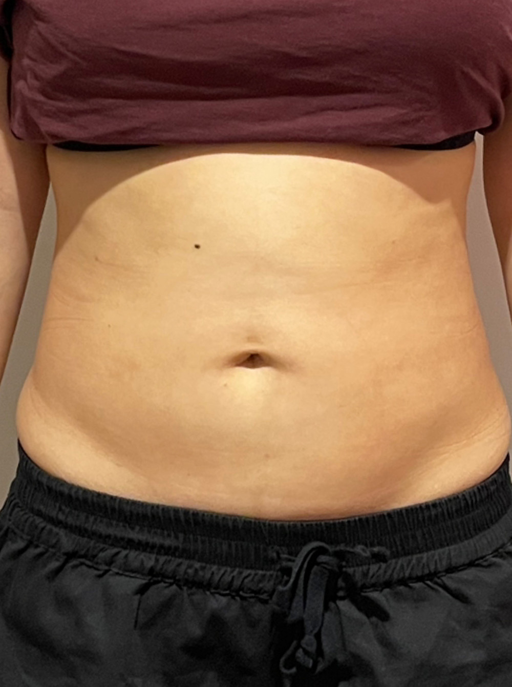 CM Slim After Treatment