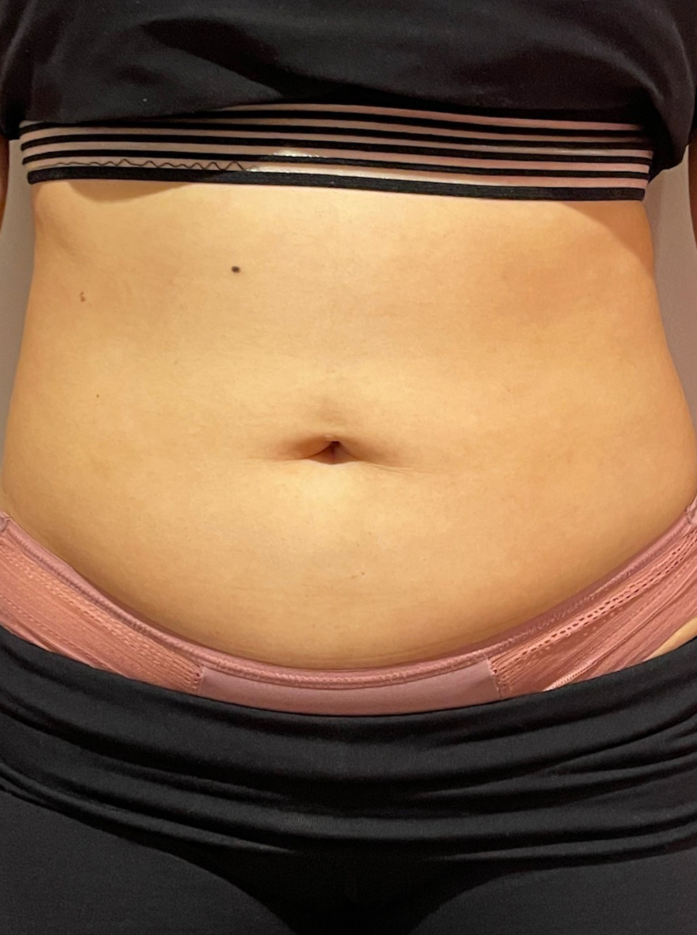 CM Slim Before Treatment