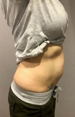 hipro-v-body-after