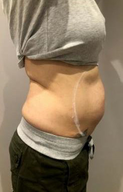 hipro-v-body-before