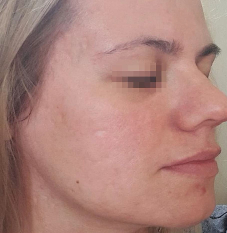 PDRN After 5 Skin treatments